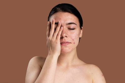 Kulit Iritasi Setelah Pakai Skincare? Ini Tanda Gak Cocok dan Cara Mengatasinya