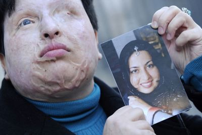 Kisah Ameneh Bahrami Wanita yang Disiram Air Keras Usai Menolak Lamaran Pria