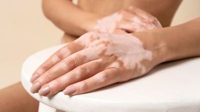 Apakah Vitiligo Bisa Sembuh atau Hanya Dikontrol? Ini Faktanya