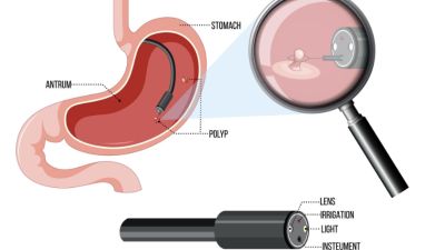 Mengenal Prosedur Endoskopi Lambung untuk Diagnosa Gastritis