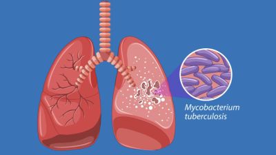 Pemahaman Mendalam tentang Tuberkulosis Paru: Diagnosis dan Pengobatan yang Efektif