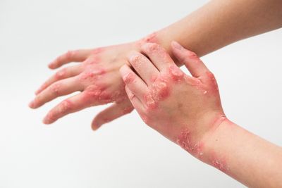 5 Cara Menghilangkan Kurap Secara Alami tanpa Obat Kimia!