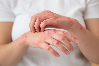 Eksim Sering Kambuh? Simak Penyebab dan Cara Meredakannya