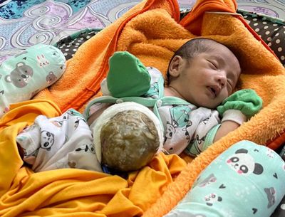 Bayi di Pandeglang Alami Kelainan Usus Langka, Keluarga Buruh Gembala Kambing Butuh Uluran Tangan