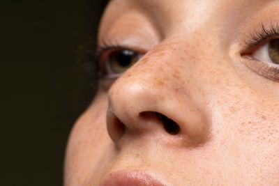 Muncul Bintik Hitam di Wajah? Ini Faktor Pemicunya