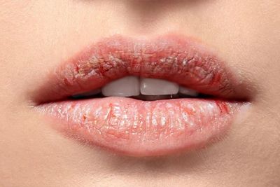 7 Tips Atasi Bibir Kering dan Pecah-Pecah yang Direkomendasikan Dokter Kulit