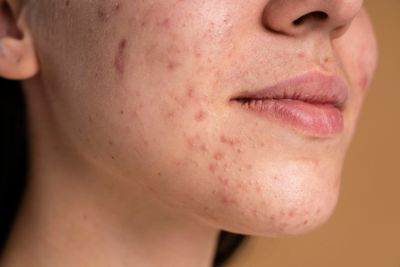 Berbeda dari Jerawat Biasa, Kenali Penyebab dan Pengobatan Fungal Acne