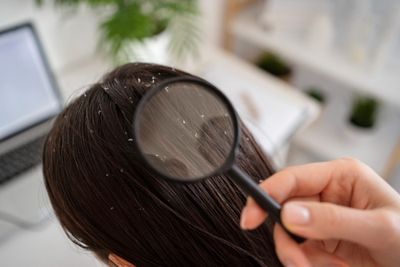 Ketombe Susah Hilang? Ini Rahasia Alami agar Rambut Bersih dan Sehat