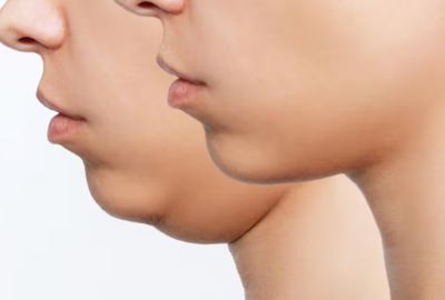 Tips Ampuh Kurangi Double Chin, dari Senam Wajah hingga Treatment