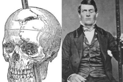 Kisah Phineas Gage, Pria yang Selamat Meski Kepalanya Tertembus Besi!
