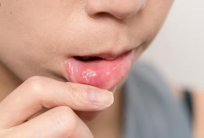 Sariawan Bikin Susah Makan? Begini Cara Mengobatinya