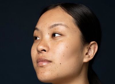 Perempuan Indonesia Rentan Alami Melasma, Flek di Wajah yang Sulit Hilang