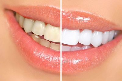 Bleaching Gigi Tidak Bisa Dilakukan Oleh Semua Orang