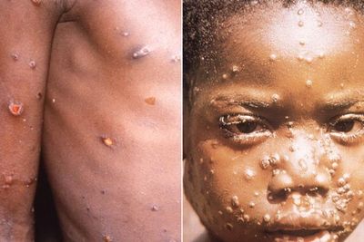 Info! Apakah Monkeypox Atau Cacar Monyet Bisa Sembuh Sendiri?