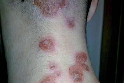 Ini Perbedaan Monkeypox & Impetigo