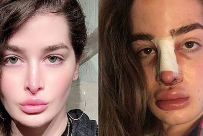 Wanita Ini Kecanduan Oplas, Lantaran Saat Kecil Sering Di-bully