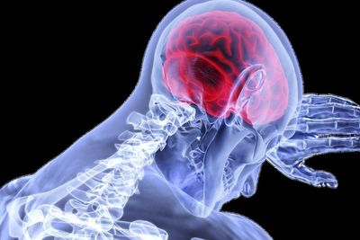 Penyakit Stroke Kini Rentan di Usia Muda, Apa Penyebabnya?