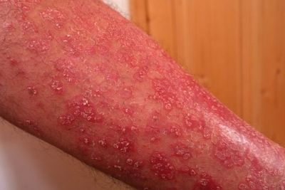 Apa yang Dimaksud Penyakit Psoriasis? 
