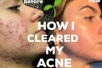 Begini Cara Atasi Jerawat Parah Tanpa Perawatan Mahal & Skincare