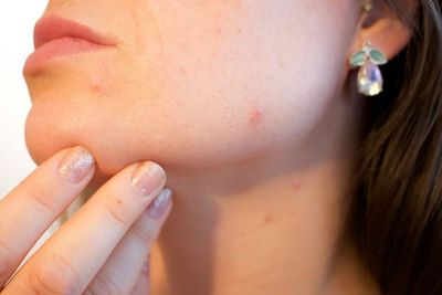 Bisakah Acne Patch Mengatasi Jerawat?