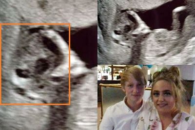 Hasil USG Bayi Mirip Alien, Pasutri Ini Syok