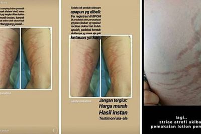 Efek Samping Penggunaan Lotion Abal-abal Bikin Striae Atrofi