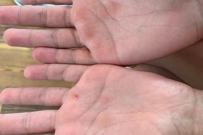 3 Cara Mengatasi Kapalan Pada Tangan