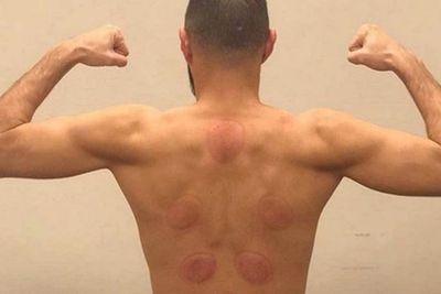 Demi Pemulihan, Karim Benzema Jalani Terapi Bekam