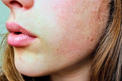 8 Kondisi Fisik Penyebab Kulit Bersisik