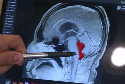 Sakit Kepala Tak Sembuh-sembuh, Ternyata Ada Cacing Pita di Otak