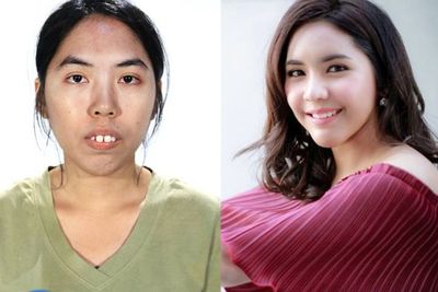 Ini Perbedaan Operasi Plastik di Korea Selatan dan Thailand