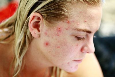 Jerawat hingga Penuaan Dini, Ini Tanda Hormonmu Tidak Seimbang