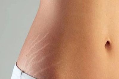 7 Cara Menghilangkan Stretch Mark Secara Alami, Biar Kulit Mulus Kembali!