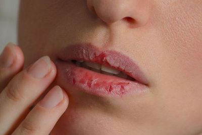 Bibir Kering? Kenali Penyebab dan Cara Perawatannya di Rumah