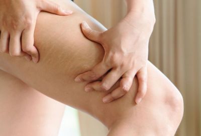 3 Campuran Minyak Ini Dinilai Ampuh Hilangkan Stretch Mark