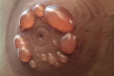 30 Menit Tertidur Selama Terapi Bekam, Kulit Wanita Ini Malah Melepuh