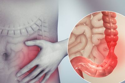 Apa Itu Sindrom Iritasi Usus atau Irritable Bowel Syndrome? Kenali Gejalanya!