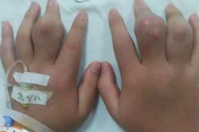 Remaja Ini Tak Bisa Gerakkan Tangan dan Kaki Karena Kebanyakan Minum Boba