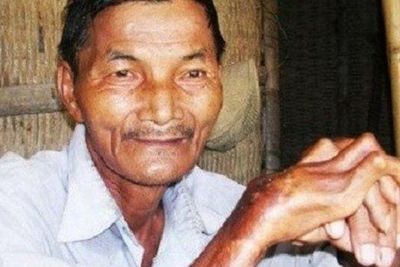 Pengakuan Seorang Pria yang Tidak Bisa Tidur Selama 33 Tahun, Derita Insomnia Akut