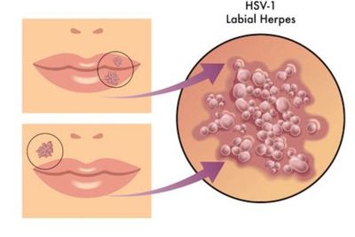 Herpes: Gejala, Penyebab dan Pengobatannya