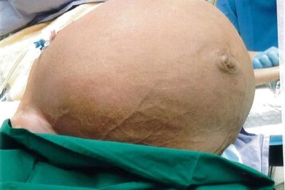 Perut Wanita Ini Membesar karena Tumor Ovarium, Beratnya Sampai 50 Kilogram