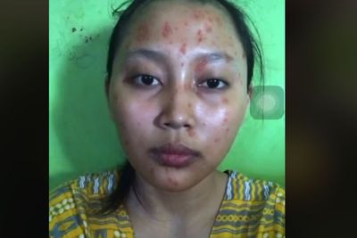 Cewek Prank Kekasihnya dengan Filter Wajah Penuh Jerawat, Reaksi Kekasihnya Bikin Kaget