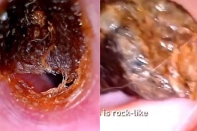 Video Pembersihan Kotoran Telinga Ini Menjijikkan, tapi Anehnya Satisfying