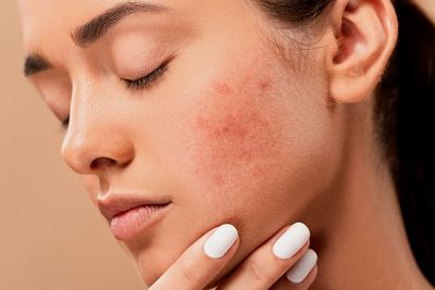 Niat Menghilangkan Jerawat, Wajah Malah Bengkak dan Susah Nafas? Reaksi Benzoyl Peroxide Ini Bisa Bahaya!