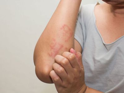 5 Cara Ampuh Meredakan Gatal Kulit Eksim dengan Mudah
