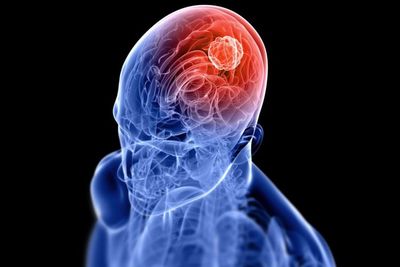 Tumor Otak: Jenis, Penyebab, Gejala, Diagnosis dan Pengobatan