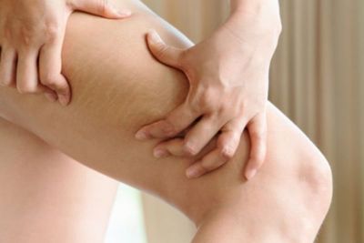 Pakai Darah Sendiri, Begini Terapi PRP untuk Hilangkan Stretch Mark