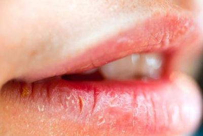5 Penyebab Bibir Pecah-pecah, dari Kebiasaan Buruk sampai Kondisi Kesehatan