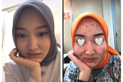 Teller Bank Cantik Mendadak Penuh Jerawat, Netizen Ungkap Penyebabnya, Bikin Merinding
