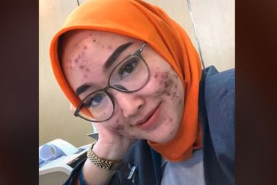 Viral Teller Bank Cantik Wajahnya Penuh Jerawat, Ternyata Penyebabnya karena Ini
